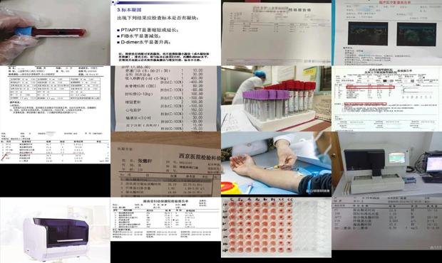 汕头血凝检查多少钱