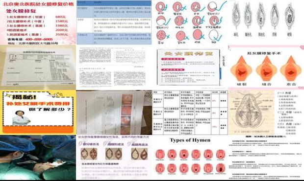 汕头处女模修复手术费用