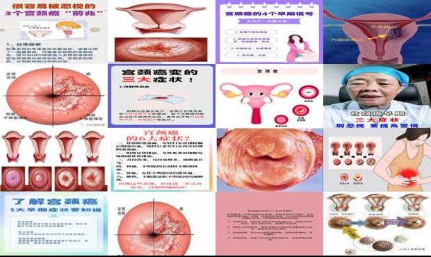 汕头宫颈*的早期症状